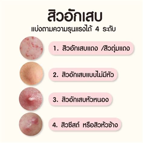 สิวอักเสบ คืออะไร พร้อมแนะนำวิธีดูแล และรักษาให้ได้ผลแบบธรรมชาติ