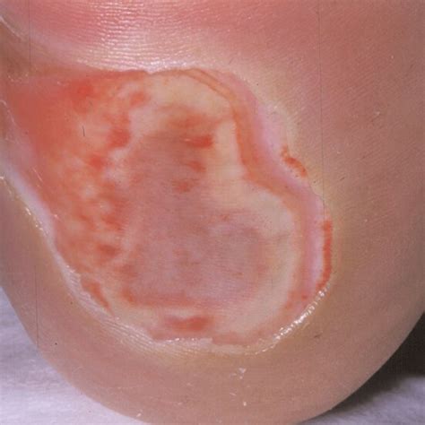 Neuropathic Ulcer Showing Migration Of Granulation Tissue Under Moist