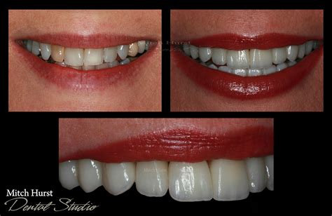 Smile Makeover Before And After Dental Cosmetic Beautiful