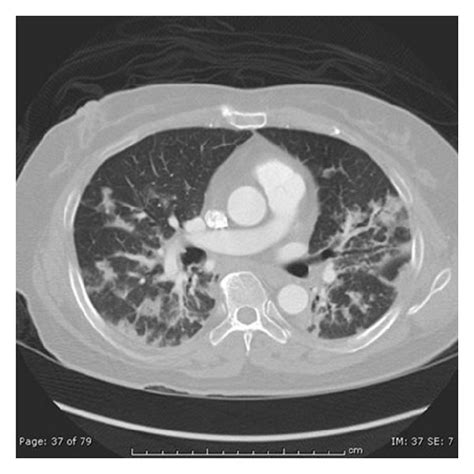 Lung Imaging On Admission A Chest Radiograph Showing Prominent