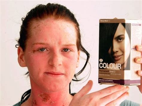 No Incidents: Hair dye causing an allergic reaction