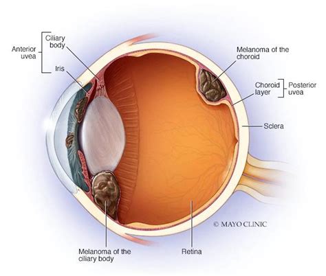 What Is Ocular Melanoma Mayo Clinic News Network