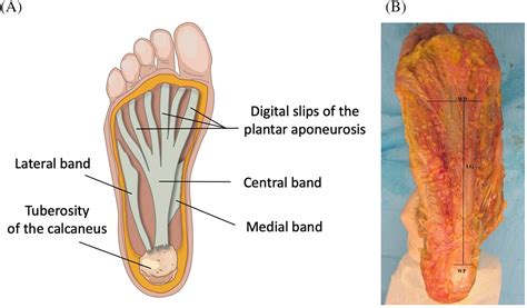 Do The Fasciae Of The Soleus Have A Role In Plantar Fasciitis