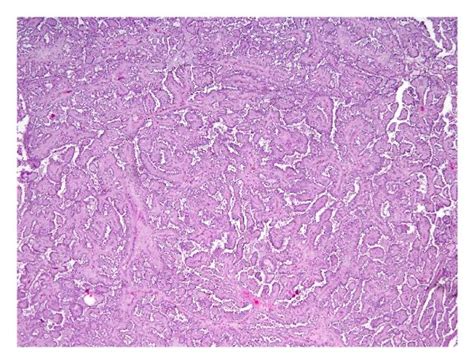 A Gross Specimen Of Right Radical Nephrectomy Demonstrating Papillary