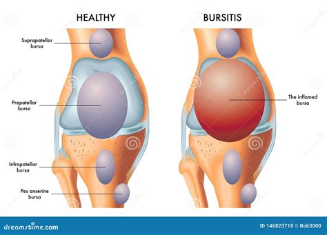 Prepatellar bursitis stock vector. Illustration of drawing - 146823718