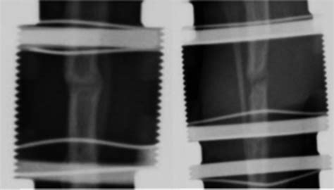 Validation Of The Use Of Radiographic Fracture‐healing Scores In A