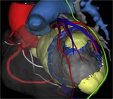 B Po05 119 Utility Of Cardiac Ct For Scar Assessment In Patients With