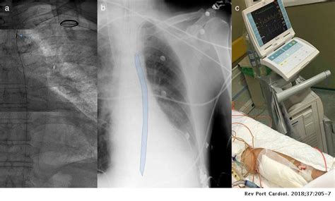 Intra Aortic Balloon Pump X Ray