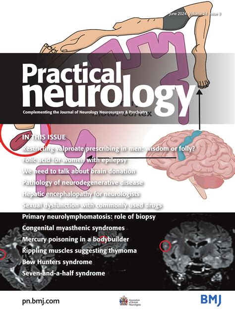 Congenital Myasthenic Syndrome From A Musk Gene Mutation Practical