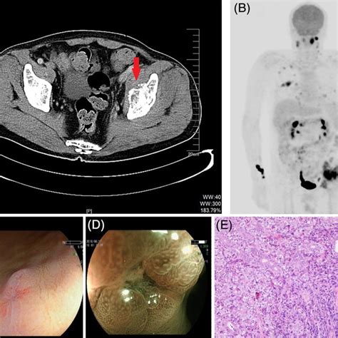 Computed Tomography Scan Of The Abdomen And Pelvic Cavity Demonstrated