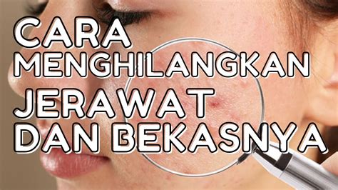 Cara Menghilangkan Jerawat Dan Bekasnya Youtube