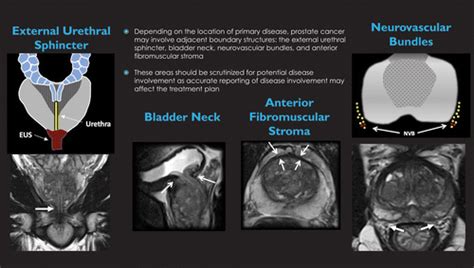 Prostate Anatomy Radiographics