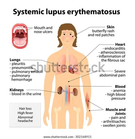 Systemic Lupus Erythematosu Sle Lupus Systemic Stock Illustration