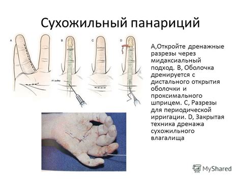 Презентация на тему: "Методы лечения гнойных заболеваний кисти Леонтьев ...