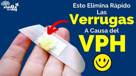 Como Eliminar Verrugas Combate Las Verrugas Con Ajo Y Lim N Remedios