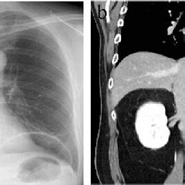 Chest X Ray CXR And Contrast Enhanced Computed Tomography CT A