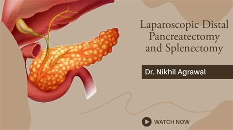 Technique Of Laparoscopic Distal Pancreatectomy And Splenectomy Dr Nikhil Agrawal