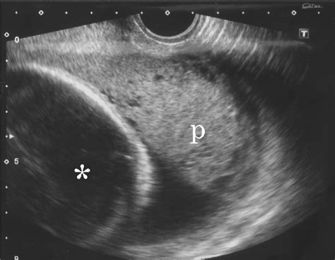 Placenta Previa On Ultrasound