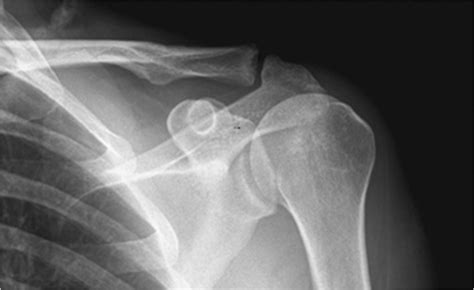 2 Arthroscopic Acromioclavicular Joint Resection Musculoskeletal Key