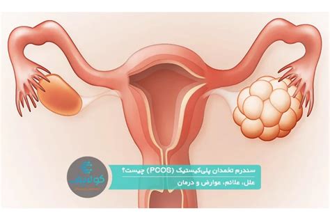 Pcos