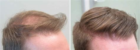 Finasteride Before and After Photos [2025]