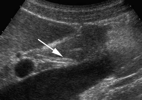 Intra Pancreatic Common Bile Duct Ultrasound Longitudinal And Slightly Download Scientific