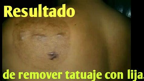 Como Quitar Un Tatuaje En Casa Al Extremo Resultado Y Como Queda