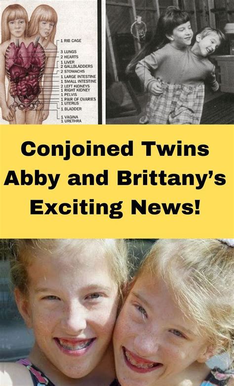 The Story Of Abby And Brittany Hensel The Famous Conjoined Twins Artofit