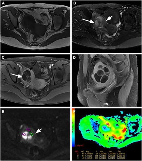 Group B Toa A 24 Year Old Woman With Right Ovarian Abscess Showing A Download Scientific