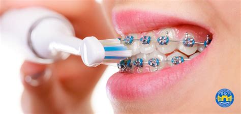 How To Brush And Floss With Braces Manhattan Bridge Orthodontics