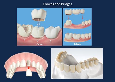 Crowns And Bridges — Smile Plant Dental