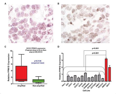 PPM1D Is Overexpressed In Primary Ovarian Clear Cell Carcinomas And