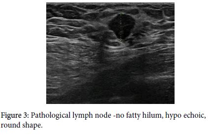 Lymph Node Hilum Ultrasound