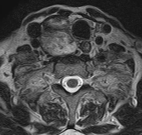 Spinal Schwannoma Image Radiopaedia Org