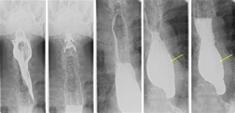 Esophageal Stricture Neoplasm Radiology Cases