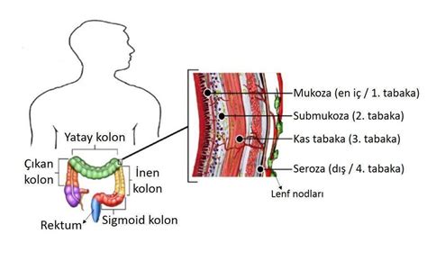 Kolon Rektum Kanseri Belirtileri Evreleri Ve Tedavisi Prof Dr
