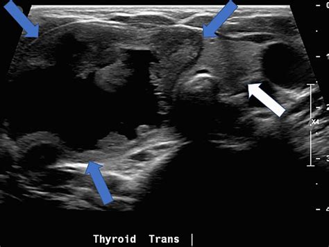 Transverse Ultrasound Image Of The Thyroid Gland Demonstrates A Download Scientific Diagram