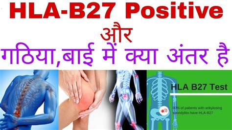 Hla B27 Positive और गठिया बाई में क्या अंतर हैankylosingspondylitisऔर