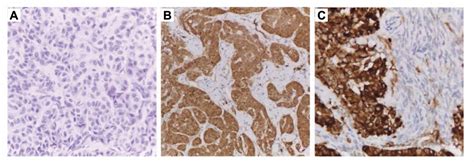 Endometrial Carcinoma Associated With Ovarian Granulosa Cell Tumors A