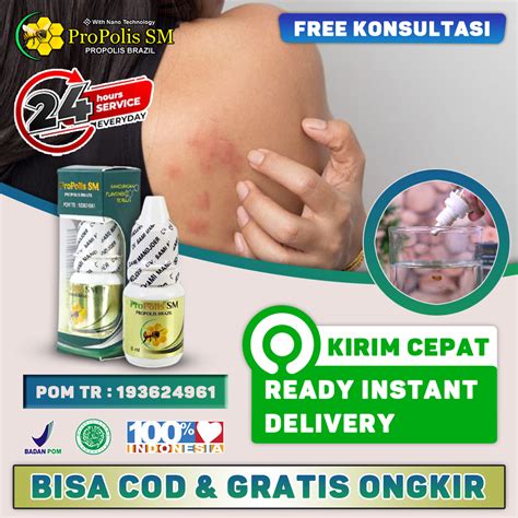 Obat Gatal Gatal Kadas Kurap Dengan Propolis Sm Obat Gatal Jamur