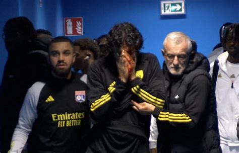 OM OL Fabio Grosso le visage en sang les premières nouvelles de