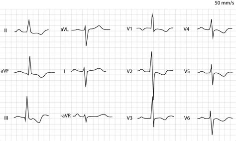 Posterior Acute Myocardial Infarction Stemi