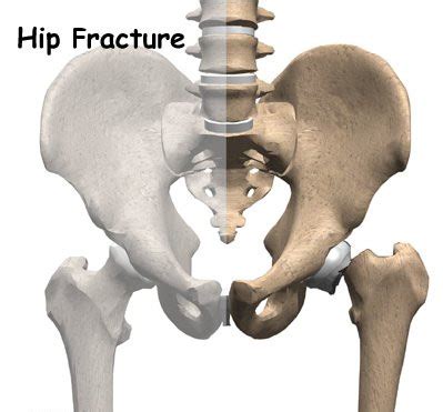 Hip fracture causes and solutions at Zehr Center, Naples, Florida