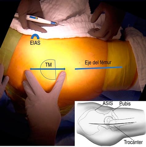 Abordaje Anterolateral Para Artroplastia Total De Cadera