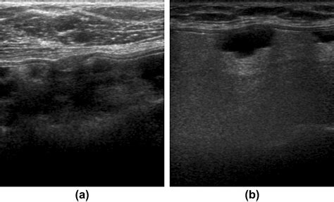 The Sonographic Appearances Of Breast Implant Rupture Clinical Radiology