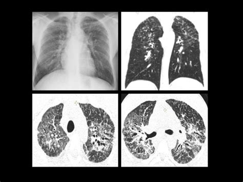 Stage IV Pulmonary Sarcoidosis In A 60 Year Old Woman Chest Radiogram