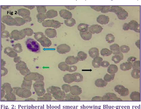 A Study Of Rapid Leishman Stain On Peripheral Blood Smear Semantic