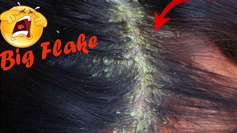 Dandruff Flakes Scratching Satisfying Itchy Scalp Flakes Youtube