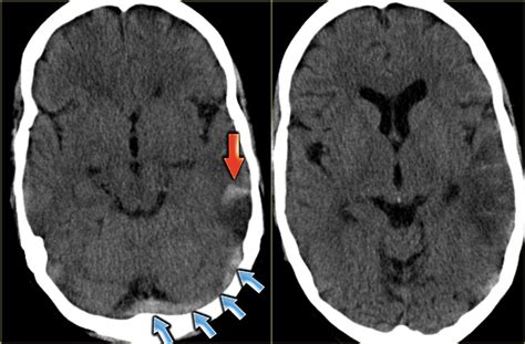 The Radiology Assistant Cerebral Venous Thrombosis