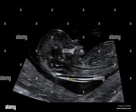 Échographie Dun Fœtus Montrant Nuchal Du Scan Pour Le Syndrome De Down